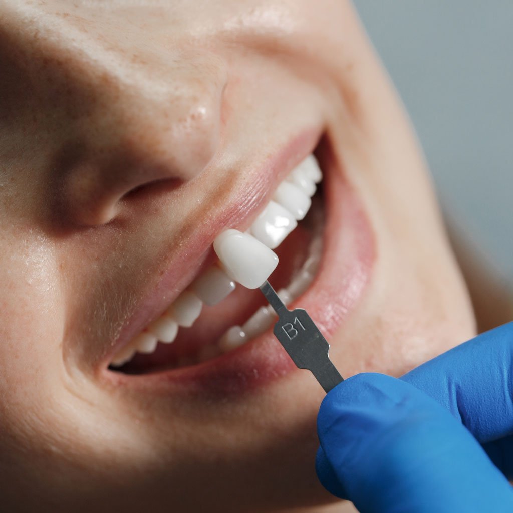 Services - Restorative Dentistry - Dental Arts of Broward