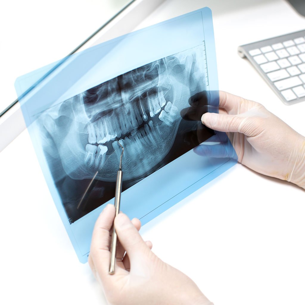 Root Canal Dental Arts of Broward